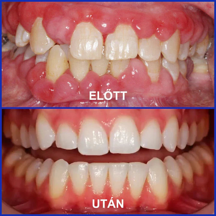 Furzero® 𝑭𝒐𝒄𝒖𝒔𝒔𝒎𝒊𝒍𝒆 – Méhméreges szájápoló por 🦷🦷