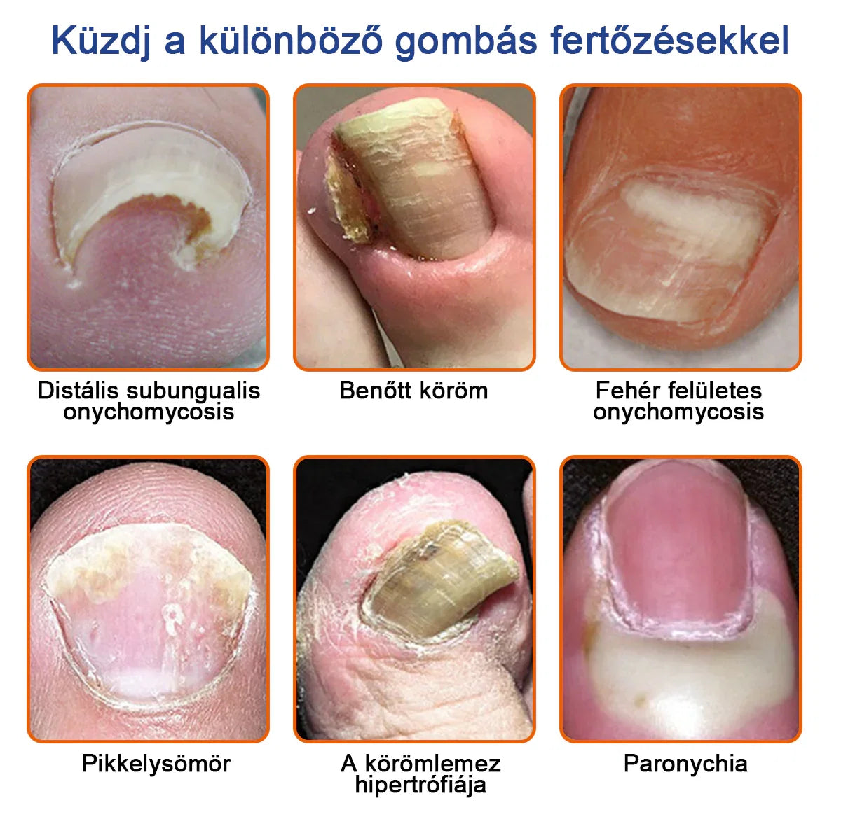 🐝Most 50% kedvezménnyel丨Furzero™ Méhméreg Körömgomba Kezelőoldat: Teljes megoldás a körömgomba problémájára🌟👣👣（Az utánvétes fizetést）