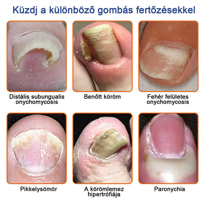 🐝Most 50% kedvezménnyel丨Furzero™ Méhméreg Körömgomba Kezelőoldat: Teljes megoldás a körömgomba problémájára🌟👣👣（Az utánvétes fizetést）