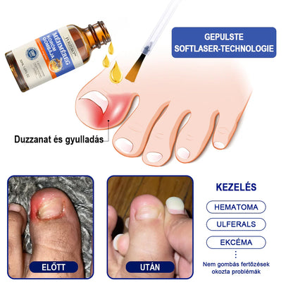 🐝Most 50% kedvezménnyel丨Furzero™ Méhméreg Körömgomba Kezelőoldat: Teljes megoldás a körömgomba problémájára🌟👣👣（Az utánvétes fizetést）