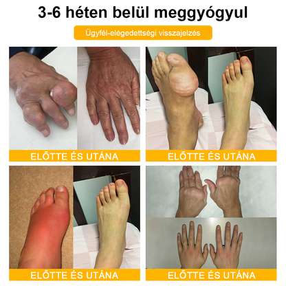 🔥Legkelendőbb丨TLOPA® Botulinum Toxin és Méhméreg Fájdalomcsillapító Csontgyógyító Krém🐝 🔥(Kifejezetten időseknek & ortopéd szakorvosok ajánlásával)🦴